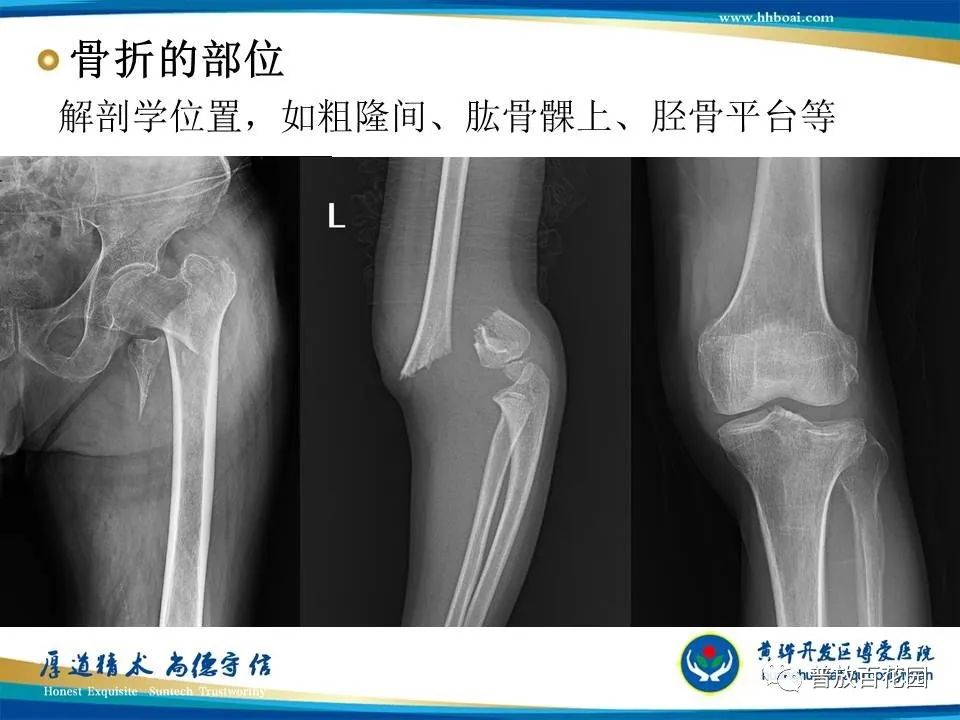 骨折诊断的影像学技术与进展解析