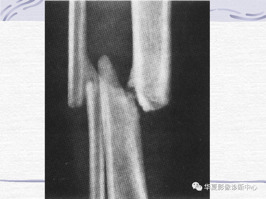 骨折诊断的影像学技术与进展解析