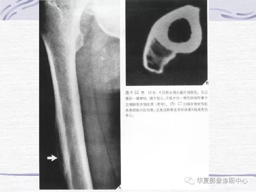 骨折诊断的影像学技术与进展解析