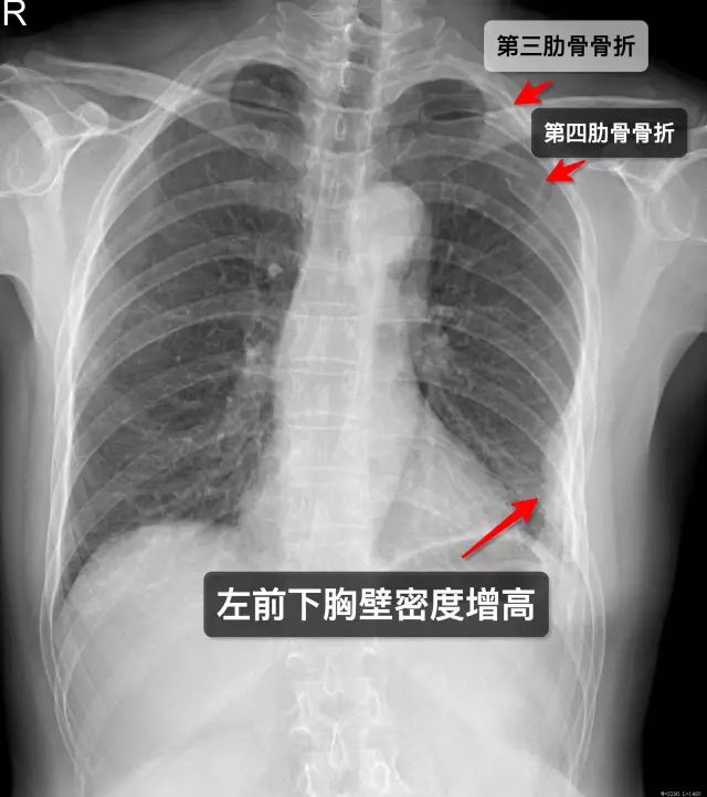 工伤评定标准：肋骨骨折如何确定工伤伤残等级