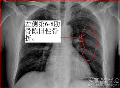 肋骨断了怎么认定工伤等级