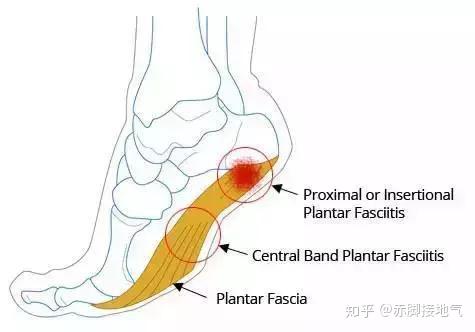 肌筋膜炎算工伤吗：能否干活、疾病严重性及自愈可能性解析