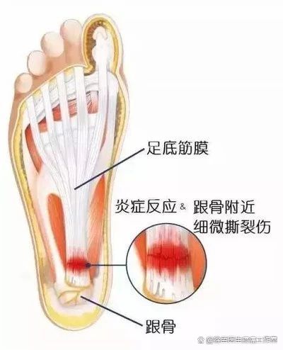 肌筋膜炎算工伤吗：能否干活、疾病严重性及自愈可能性解析