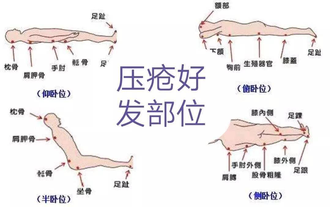 肌腱损伤更高评几级工伤及伤残等级判定标准