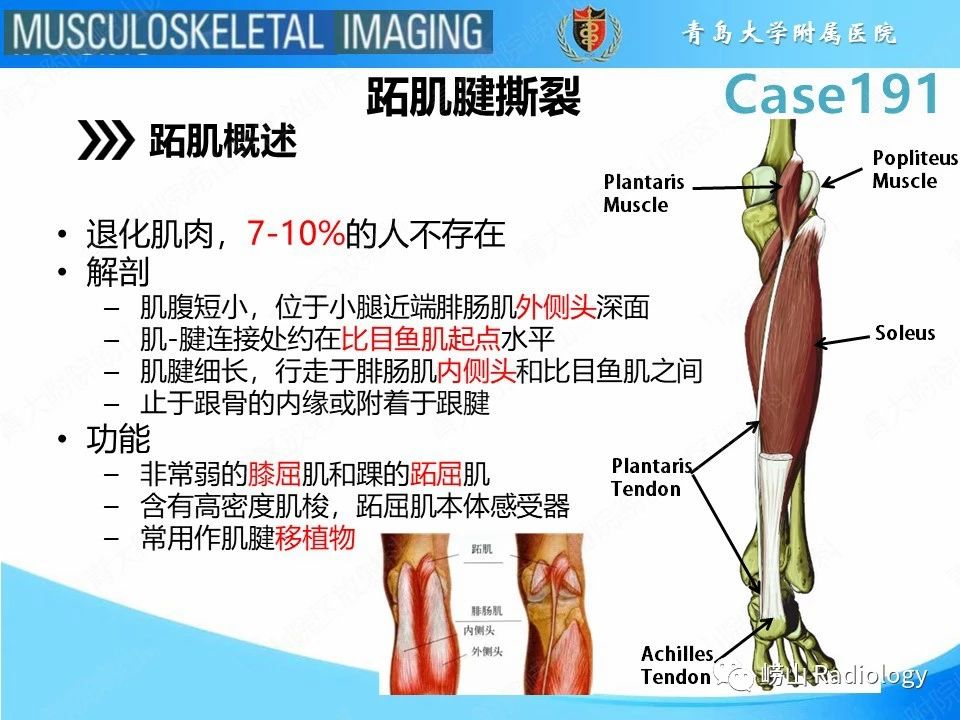 肌腱撕裂伤残评定：如何确定伤残等级及赔偿标准