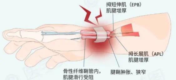 肌腱撕裂可以认定工伤吗