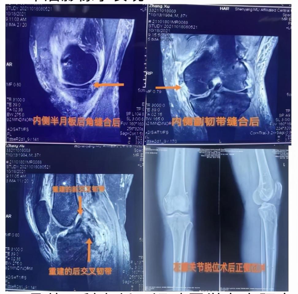 工伤认定：肌腱撕裂算工伤吗？赔偿流程及标准详解