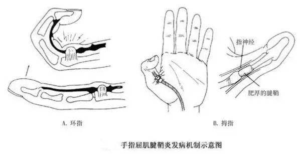 肌腱炎：探讨其是否被认定为职业病的界定与标准