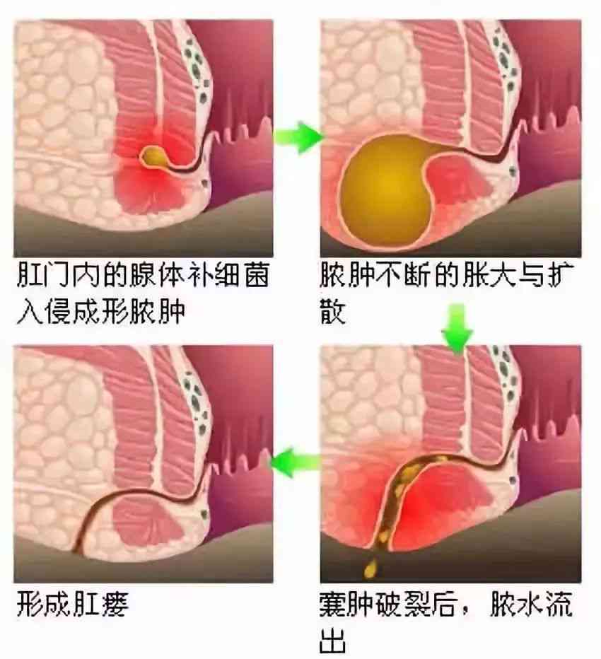 肛瘘能报工伤么：肛瘘医保报销及保险理赔详解