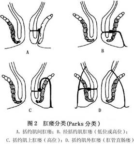 肛瘘疾病是否满足残疾评定标准：解析肛瘘评残可能性