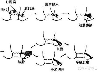 探讨肛瘘病症是否适用于工伤认定标准