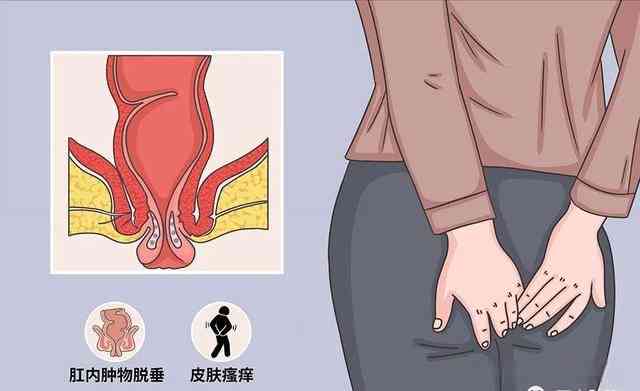 探讨肛瘘病症是否适用于工伤认定标准