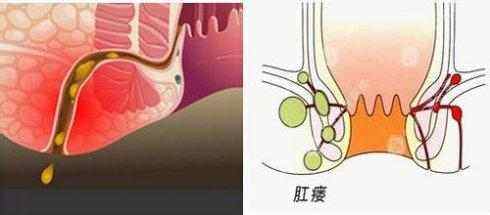 肛瘘怎么认定工伤