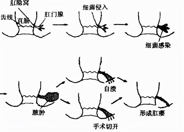 肛瘘患者能否申请残疾评定及相关条件分析