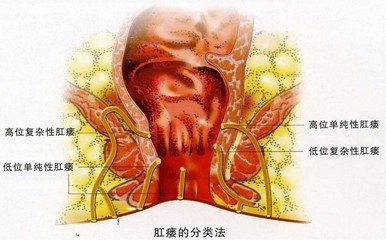 肛瘘患者能否申请残疾评定及相关条件分析