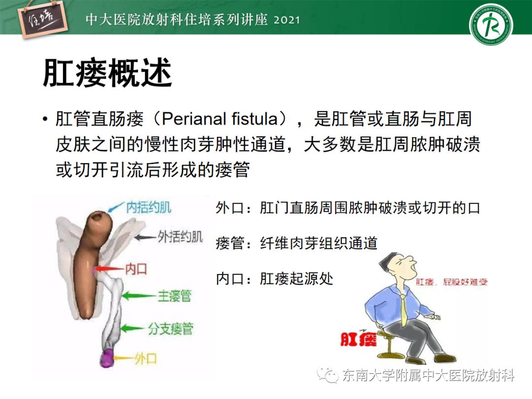 肛瘘患者是否可评定为残疾：全面解读残疾评定标准及流程