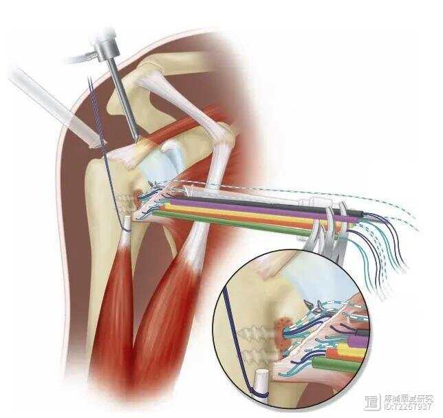 肩关节积液治疗方式解析：手术与非手术疗法的全面评估与选择