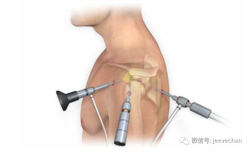 肩关节镜手术后的伤残评定标准与复影响解析