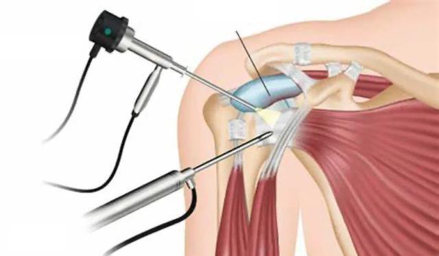 肩关节镜手术后的伤残评定标准与复影响解析