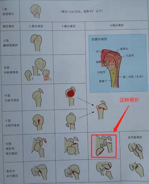 肱骨大结节能认定工伤吗：工伤赔偿金额及骨折伤残鉴定级别解析