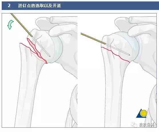 肱骨大结节能认定工伤吗：工伤赔偿金额及骨折伤残鉴定级别解析