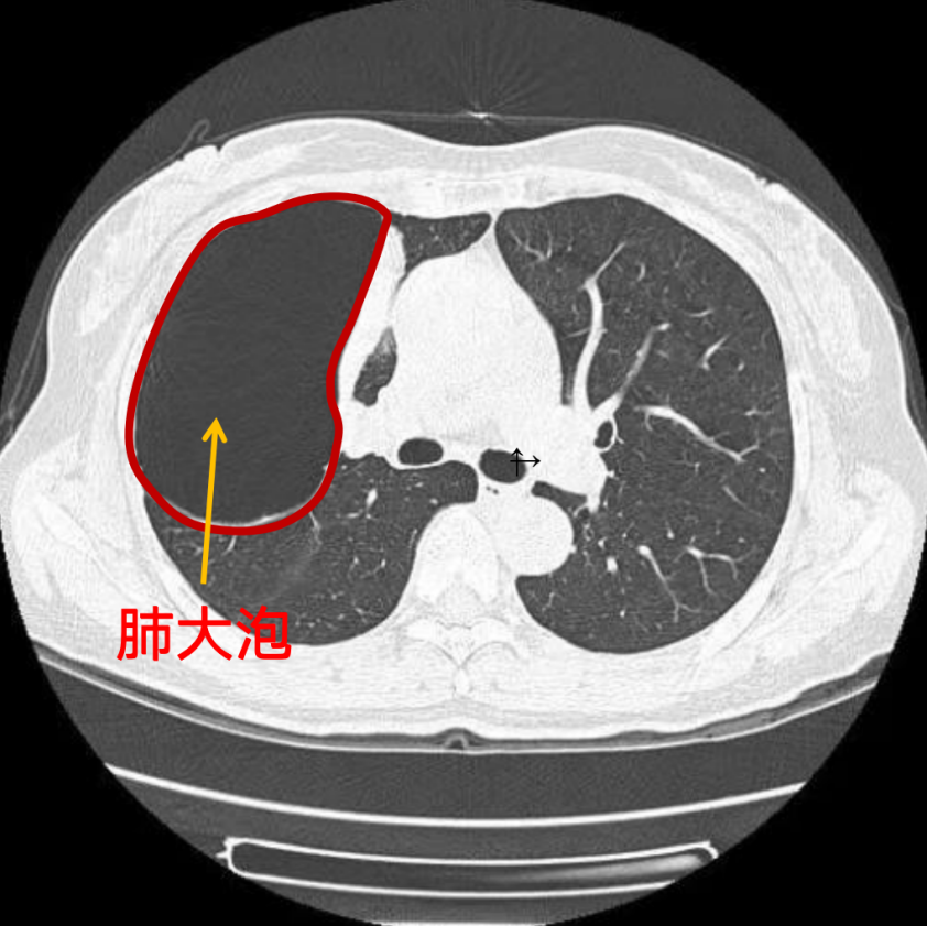 '探讨肺大泡是否属于职业性疾病——工伤认定的深度分析'