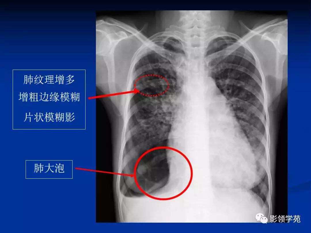 肺大泡：是否属于职业病或工伤，以及相关法律认定与补偿解读