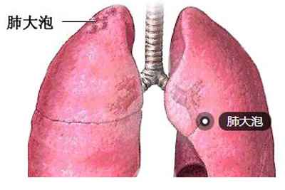 肺大泡伤残等级判定标准及伤残赔偿解析