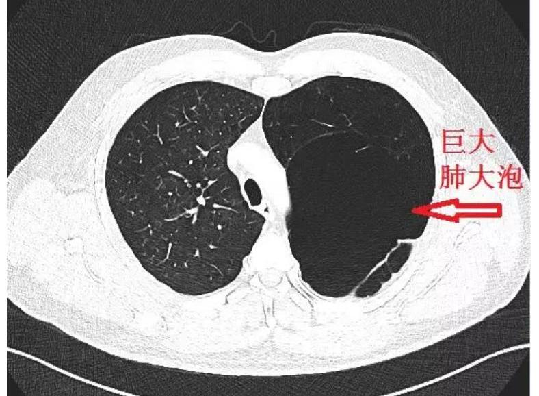 肺大泡伤残等级判定标准及伤残赔偿解析