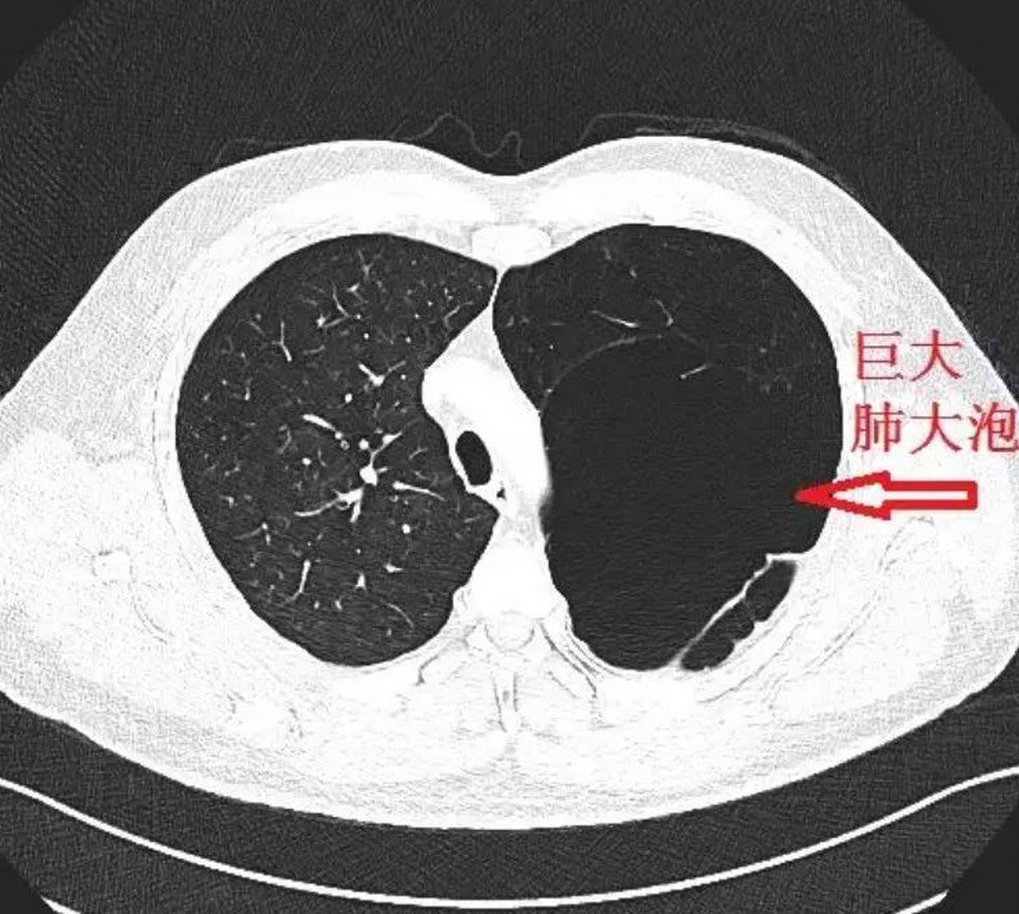 探讨肺大泡患者是否合残疾评定标准及评残流程