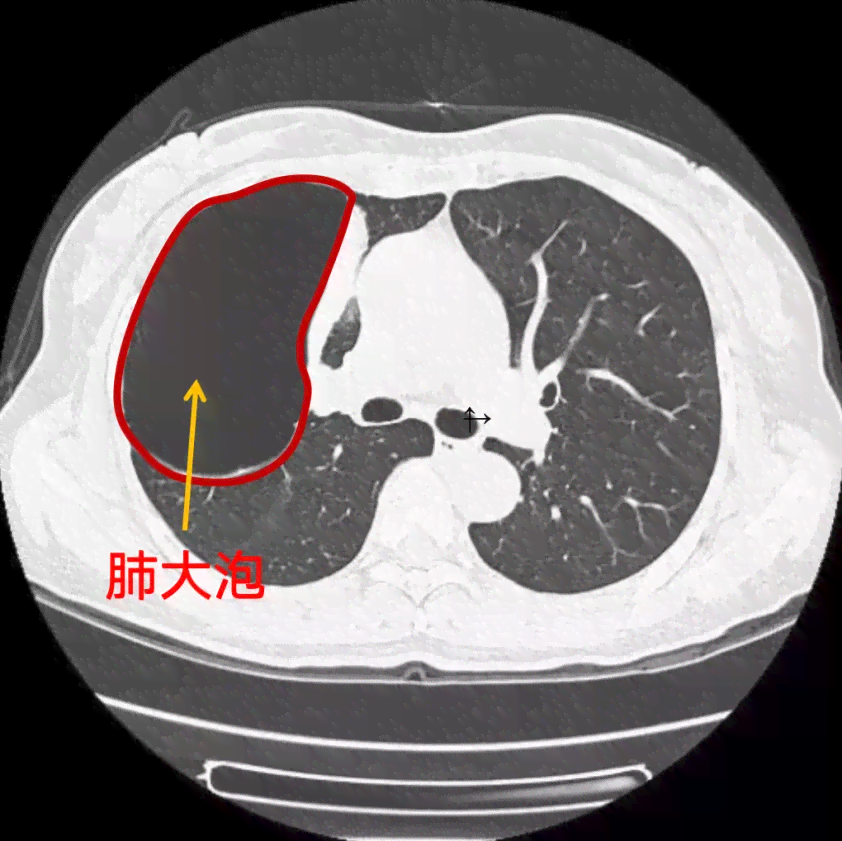 肺大泡是否属于职业病：全面解读职业性肺病分类与认定标准