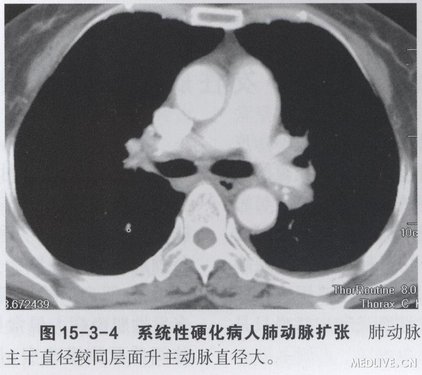 肺纤维化能评几级伤残，肺纤维化肺部纤维化伤残鉴定及评级详解