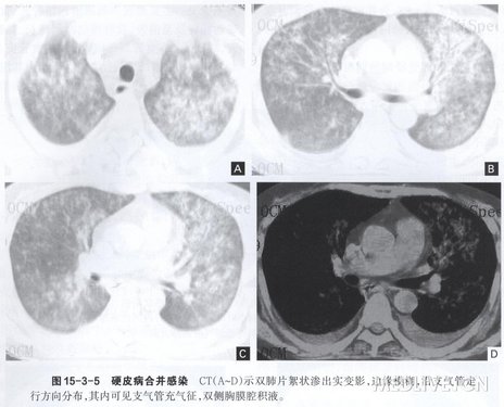 肺纤维化能评几级伤残，肺纤维化肺部纤维化伤残鉴定及评级详解