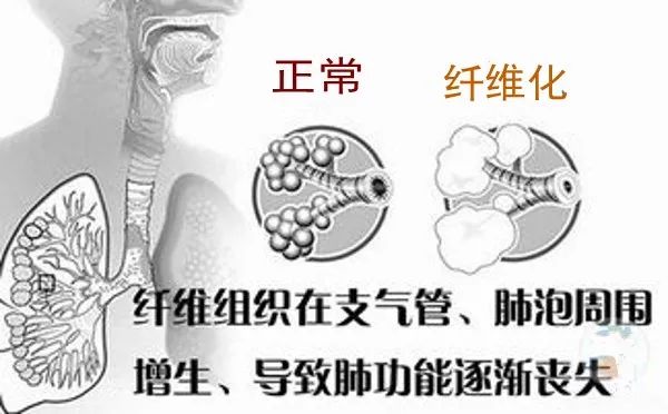 肺部纤维化伤残等级划分及对应的劳动能力鉴定标准解读