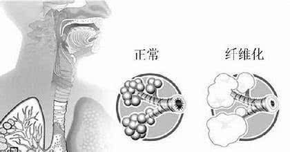 肺纤维化能认定工伤么