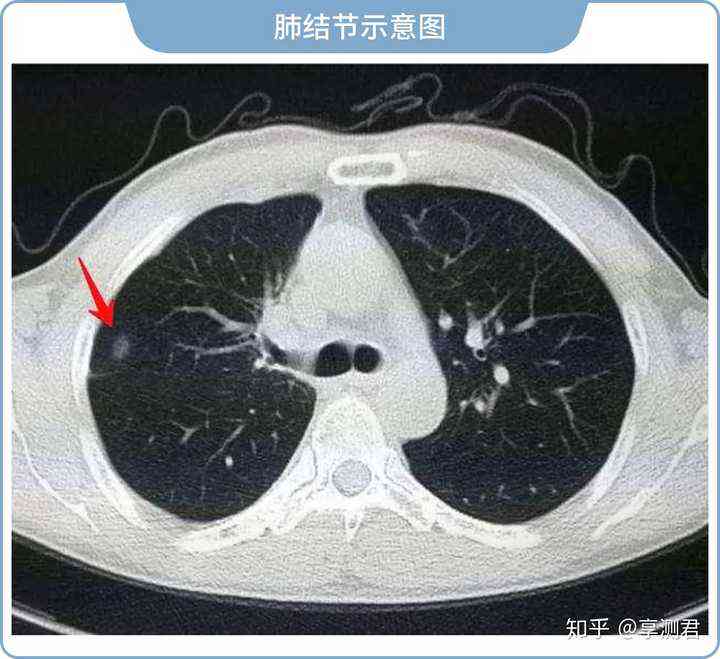 工作环境导致的肺结节：如何判定为工伤案例