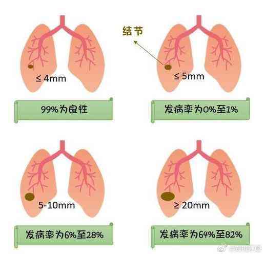 工作环境导致的肺结节：如何判定为工伤案例