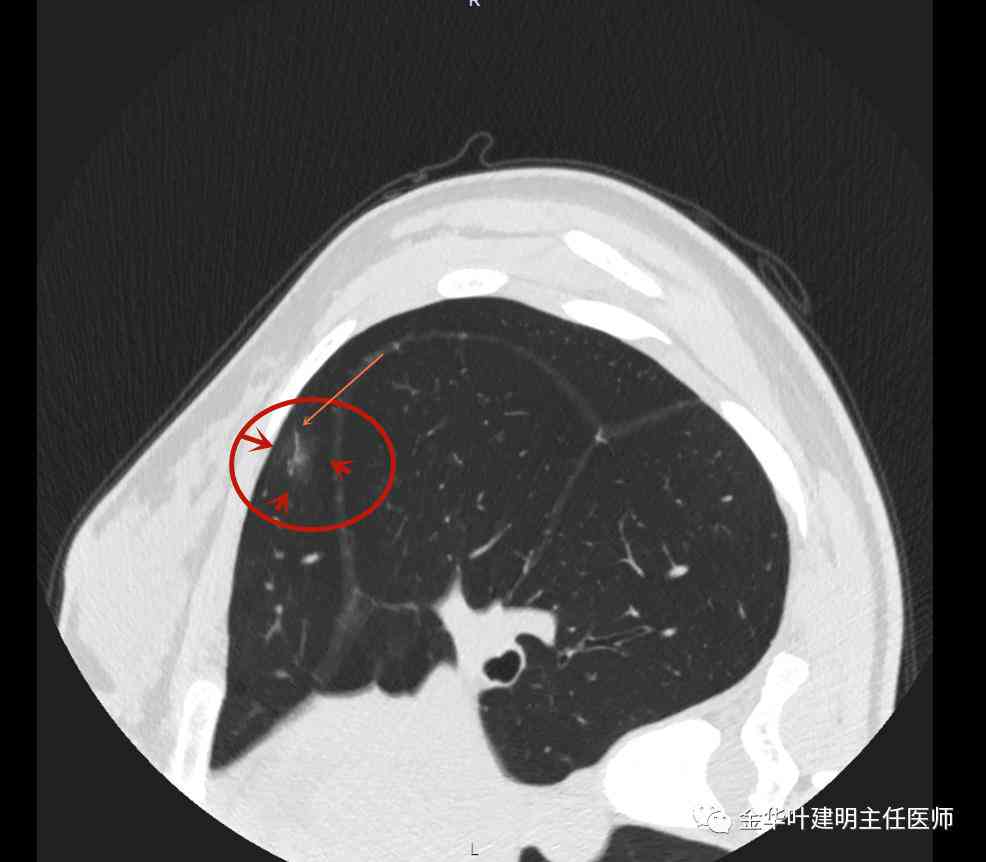 工伤认定探讨：肺结节手术是否合工伤赔偿标准