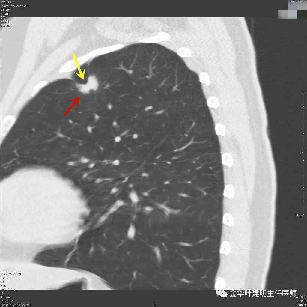 工伤认定探讨：肺结节手术是否合工伤赔偿标准