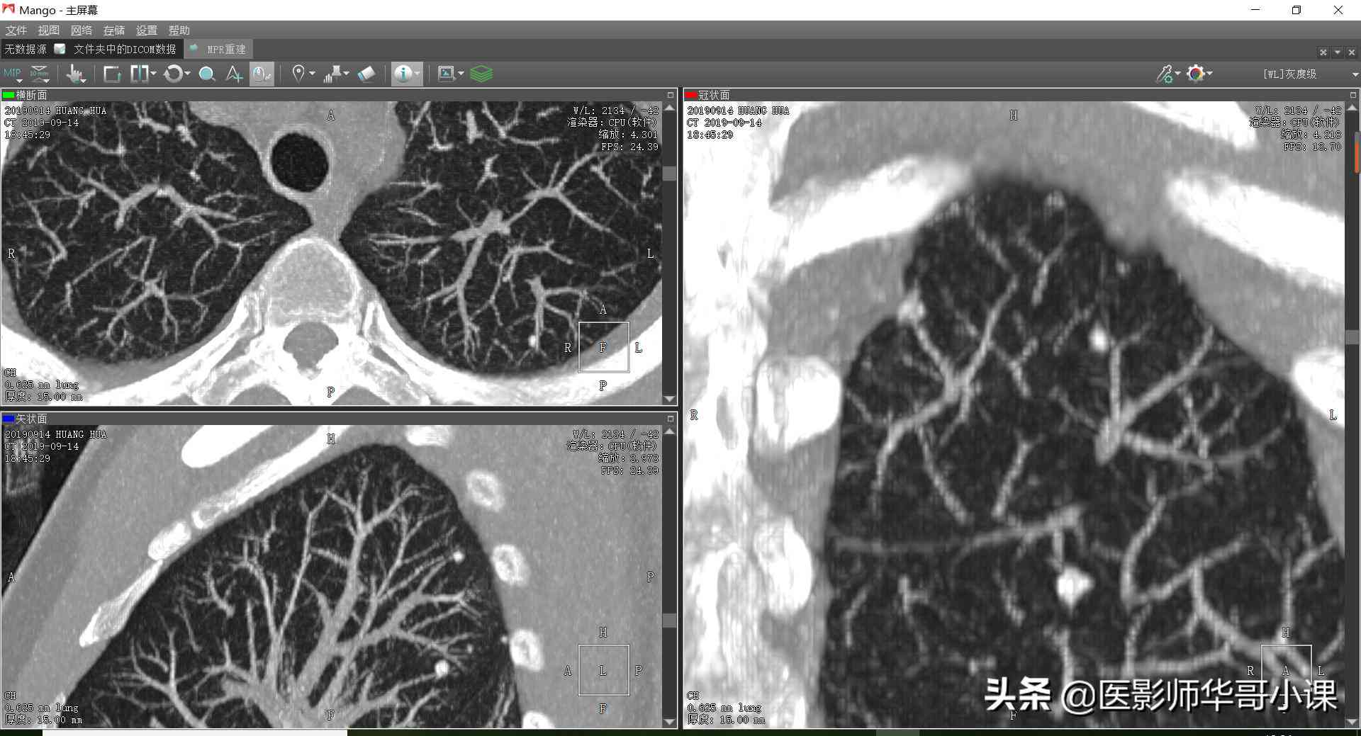 工伤认定探讨：肺结节手术是否合工伤赔偿标准