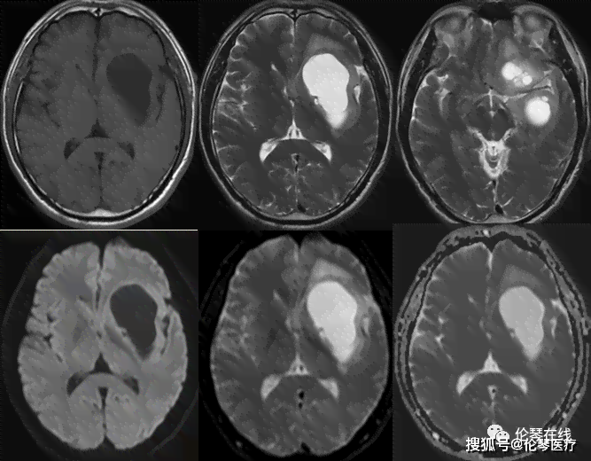 肺脓肿：探讨手术治疗的有效性与可行性