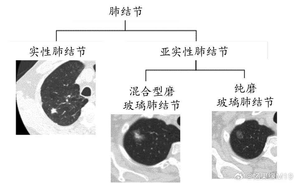 肺部结节患者能否被认定为工伤：工伤认定的法律解读与实践分析