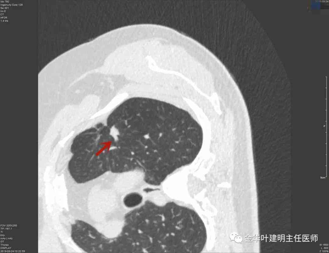 工伤鉴定：肺部结节是否合工伤申请条件