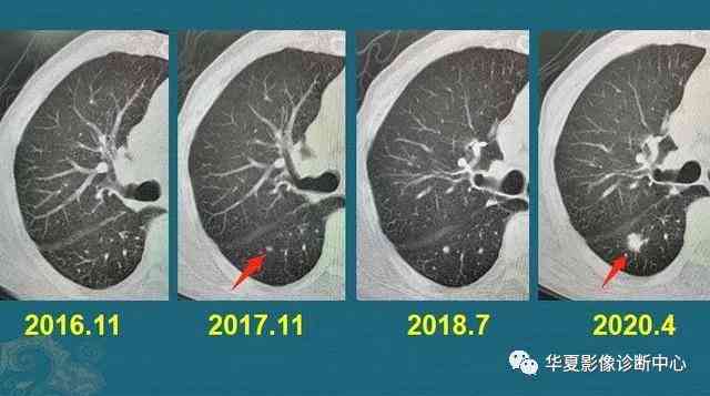 工伤鉴定：肺部结节是否合工伤申请条件