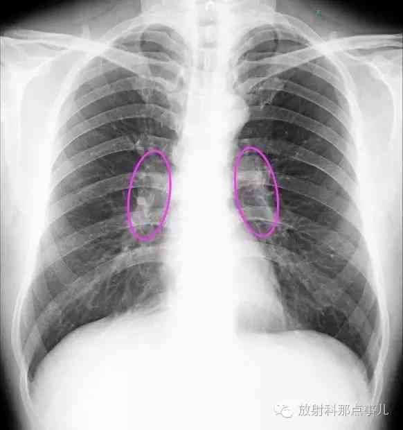 肺部肿瘤：了解其严重性、分类及治疗对策，全面解析肺部肿瘤的健影响