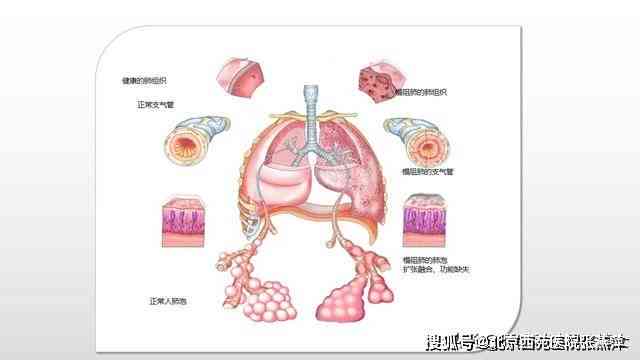 肺部肿瘤如何影响吸系统功能与肺功能健