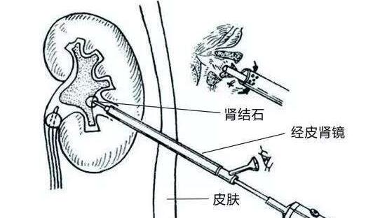 探讨肾结石职业相关性：肾结石能否被认定为工伤？