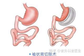 胃大切能认定工伤吗多少钱一天一个月具体费用是多少