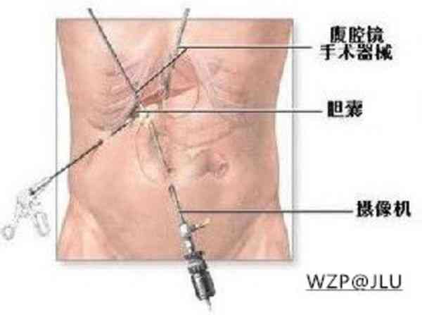 胆囊切除可以认定工伤吗：手术费用与工伤认定详解