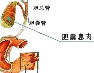 胆囊切除可以认定工伤吗